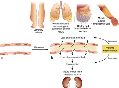 Capillary leak syndrome